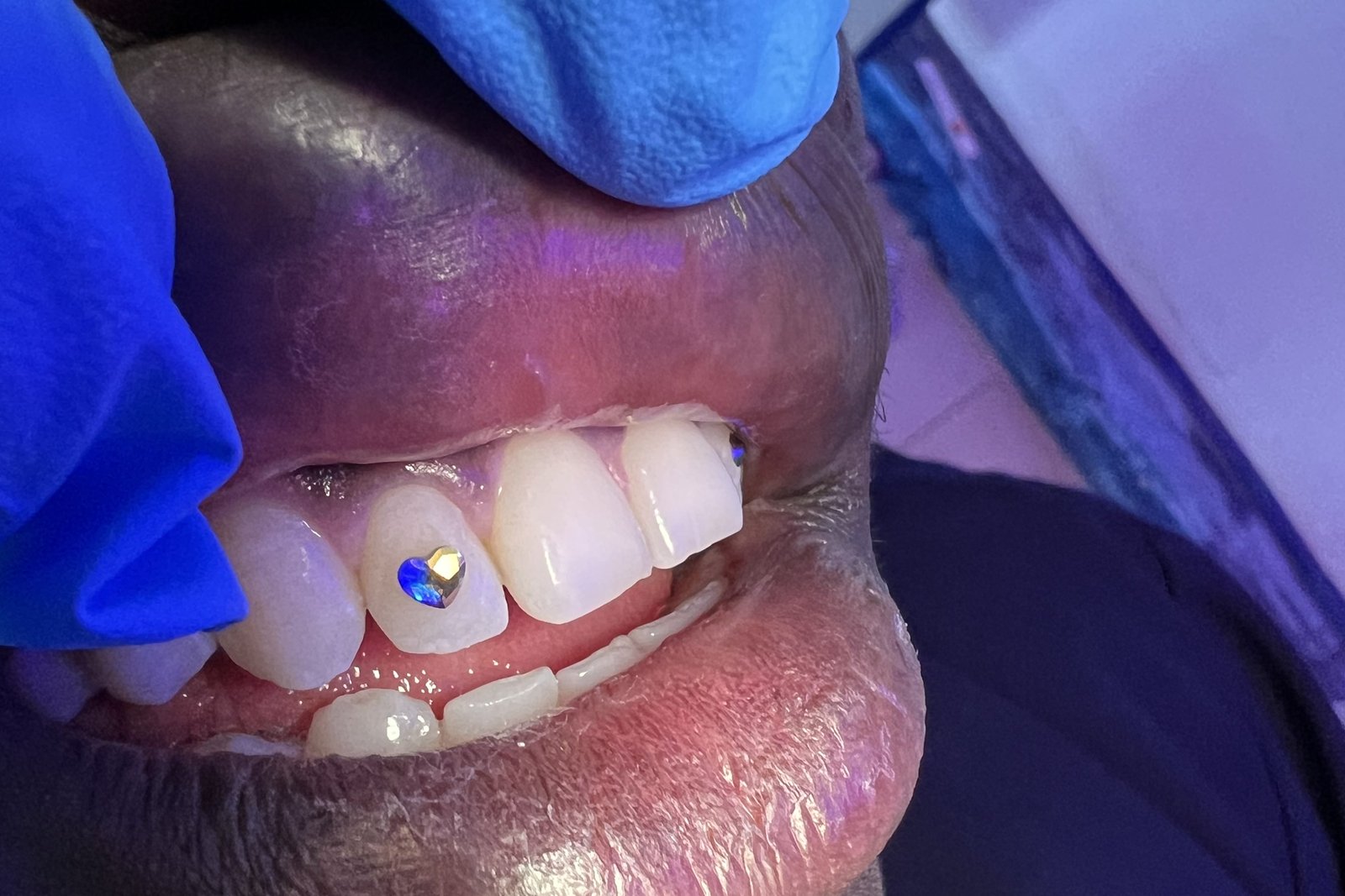 Real tooth gem with diamond and gold sparkle fitted on a patient at Piwan Dental, Gulu