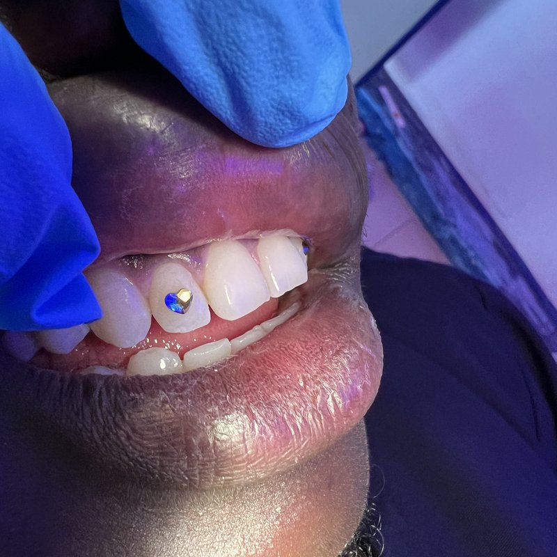 Real tooth gem with diamond and gold sparkle fitted at Piwan Dental, Gulu